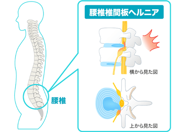 腰椎椎間板ヘルニア