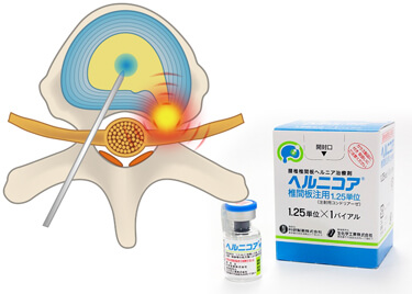 ヘルニコア（椎間板内酵素注入療法）
