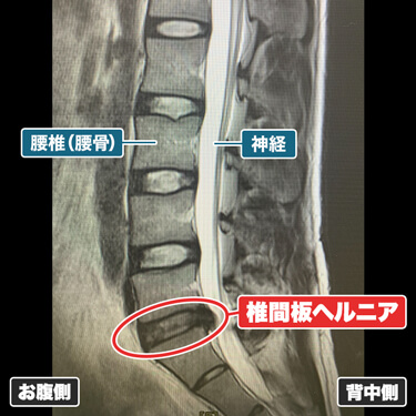 PLDDを受けた20代男性の治療前のMRI画像